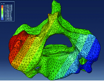 Three-dimensional finite element model for the functional spine unit C5-C6